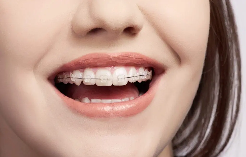 Clear (Ceramic) Braces | Dumfries Orthodontics | Potomac Pediatric Dentistry macro shot on woman mouth with braces laughing, happy expression concept.