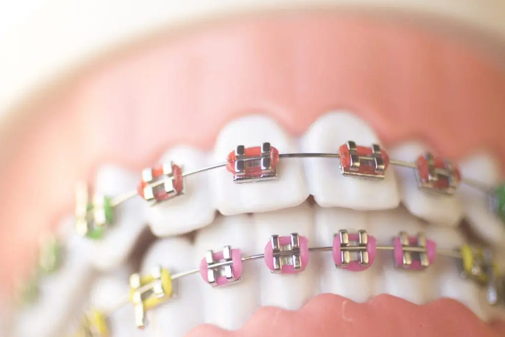 How Braces Work | Dumfries Orthodontist | Potomac Pediatric Dentistry How Braces Work | Dumfries Orthodontist | Potomac Pediatric Dentistry