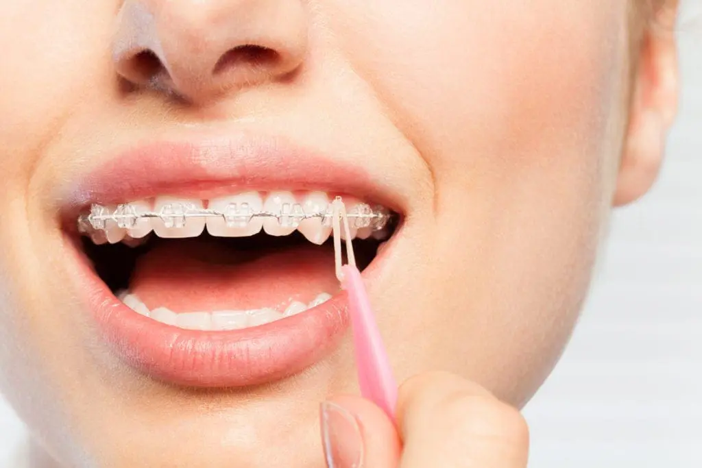 Braces Elastics | Dumfries Orthodontics | Potomac Pediatric Dentistry Braces Elastics | Dumfries Orthodontics | Potomac Pediatric Dentistry