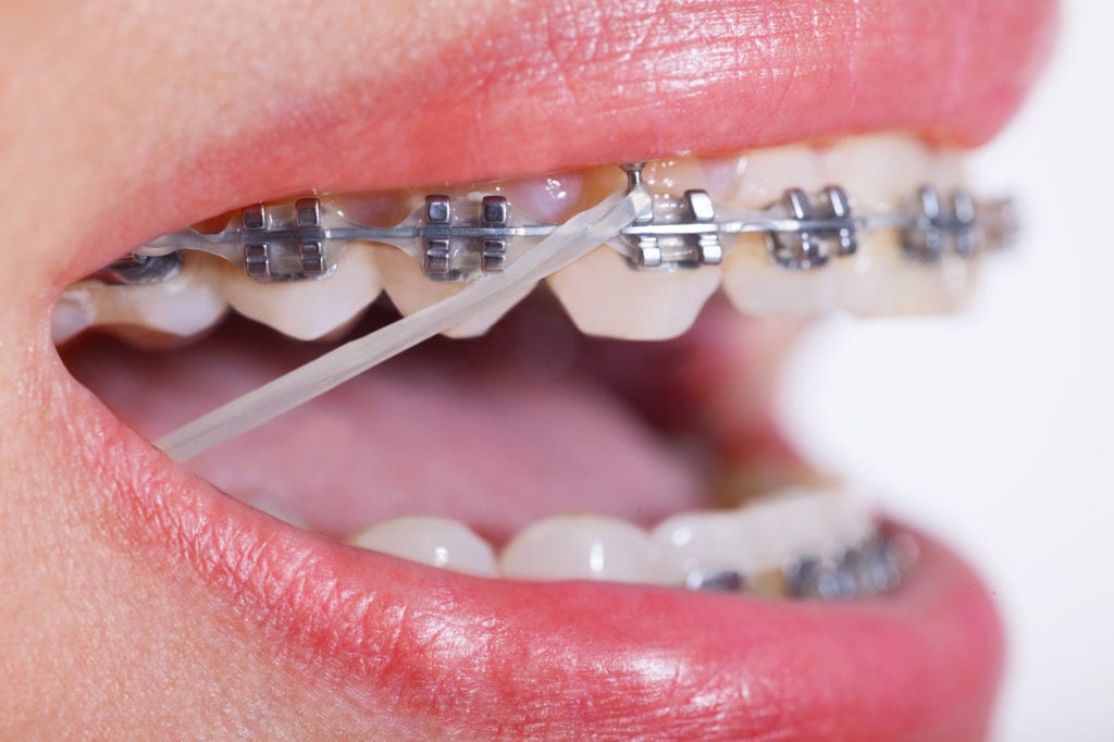 Braces Elastics | Dumfries Orthodontist | Potomac Pediatric Dentistry