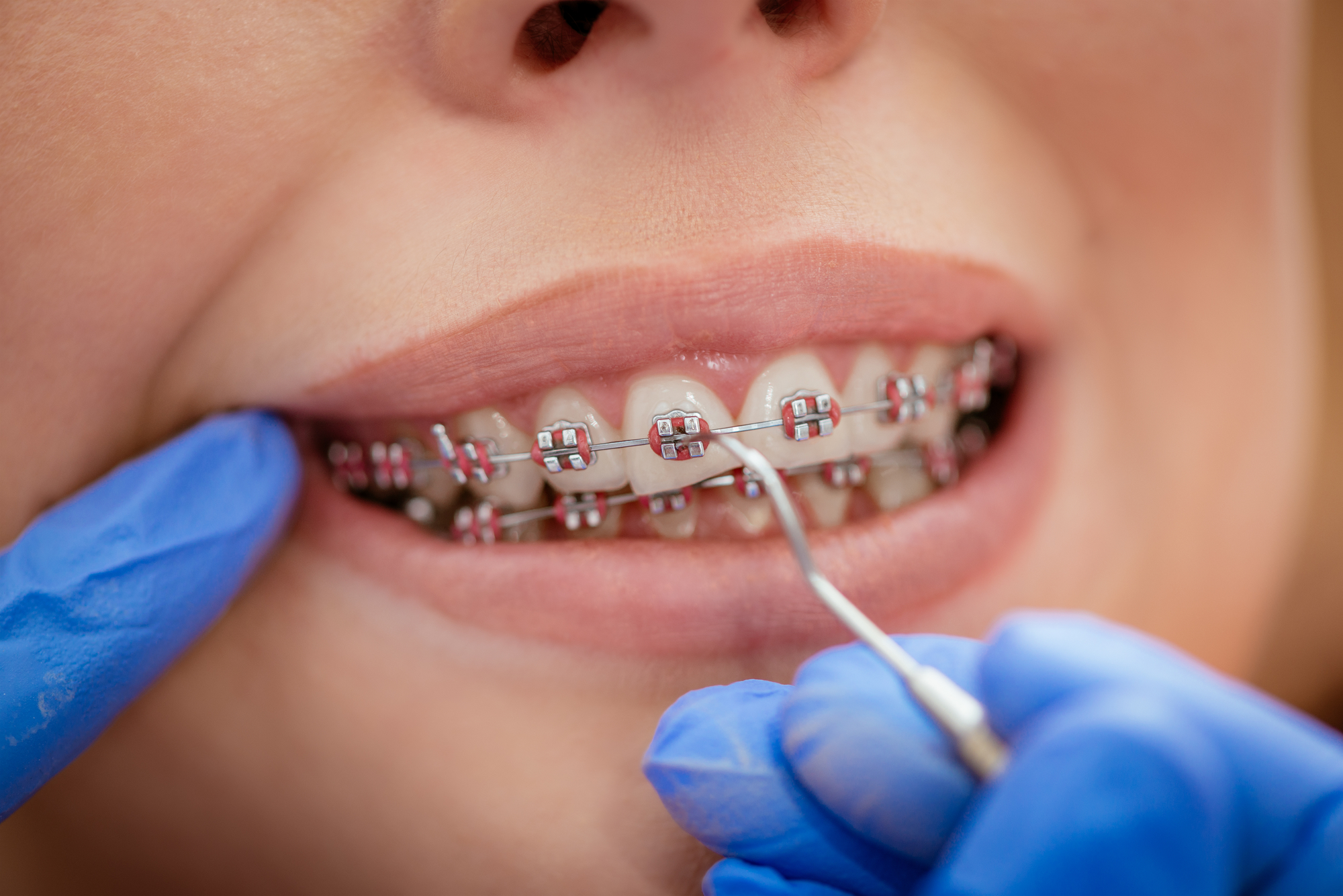 Braces Potomac Pediatric Dentistry