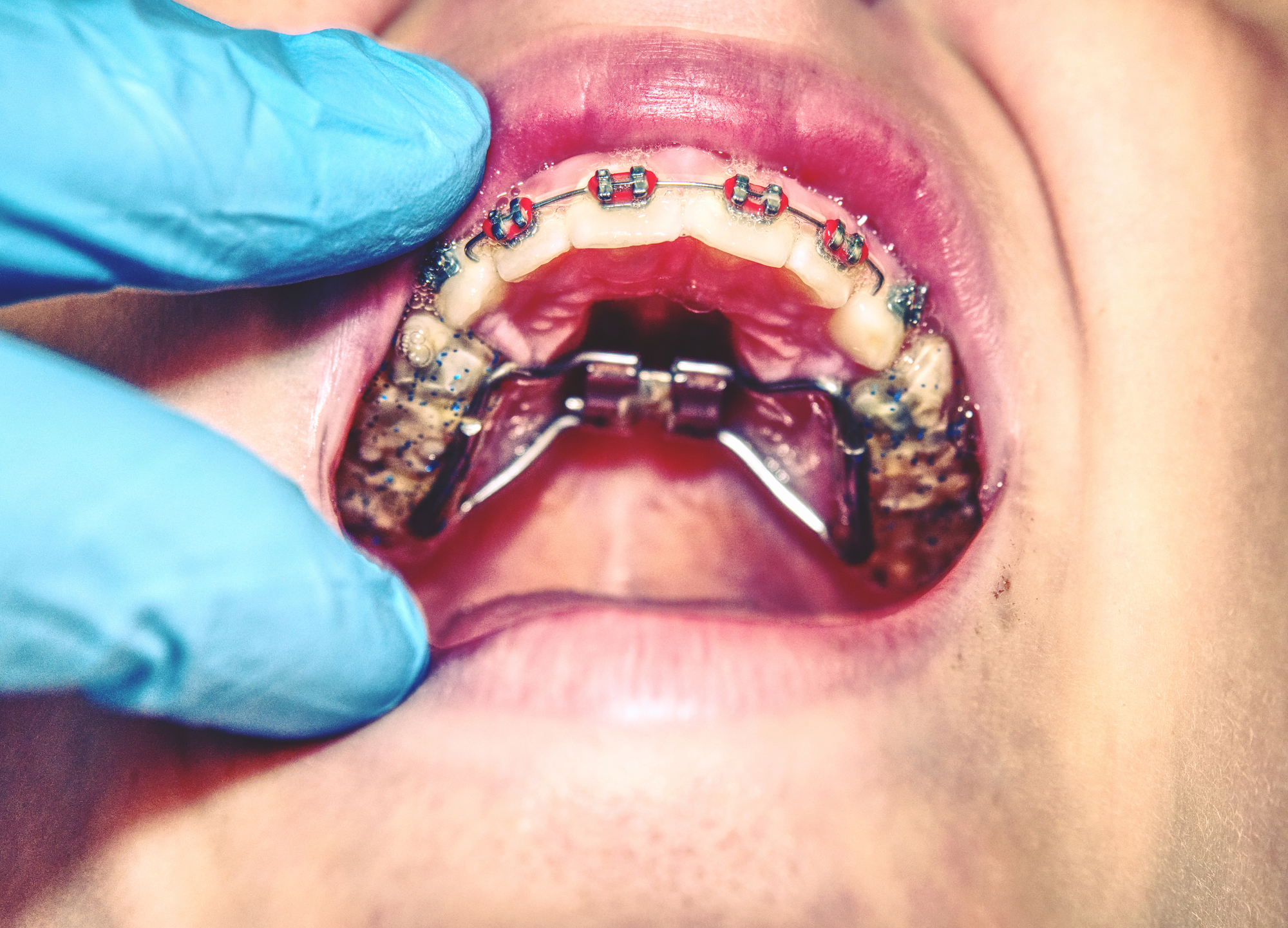 Palate Expander | Dumfries Orthodontist | Potomac Pediatric Dentistry