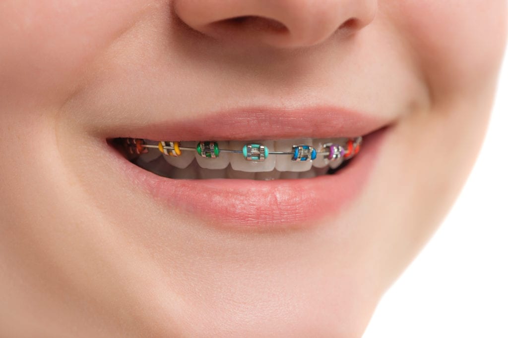 Type of Braces | Dumfries Braces | Potomac Pediatric Dentistry