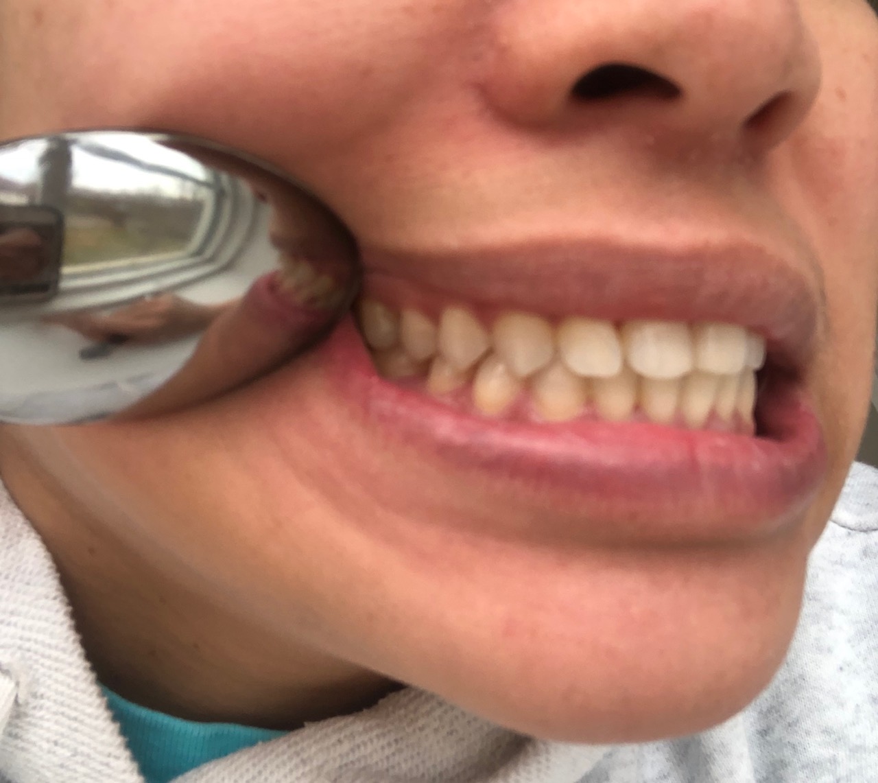 Teeth right side